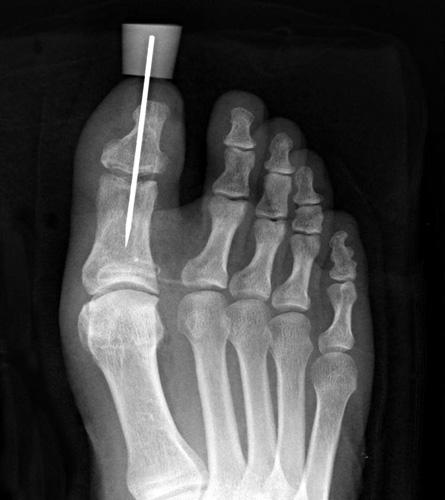 interphalangeal joint of the great toe and entrapped
