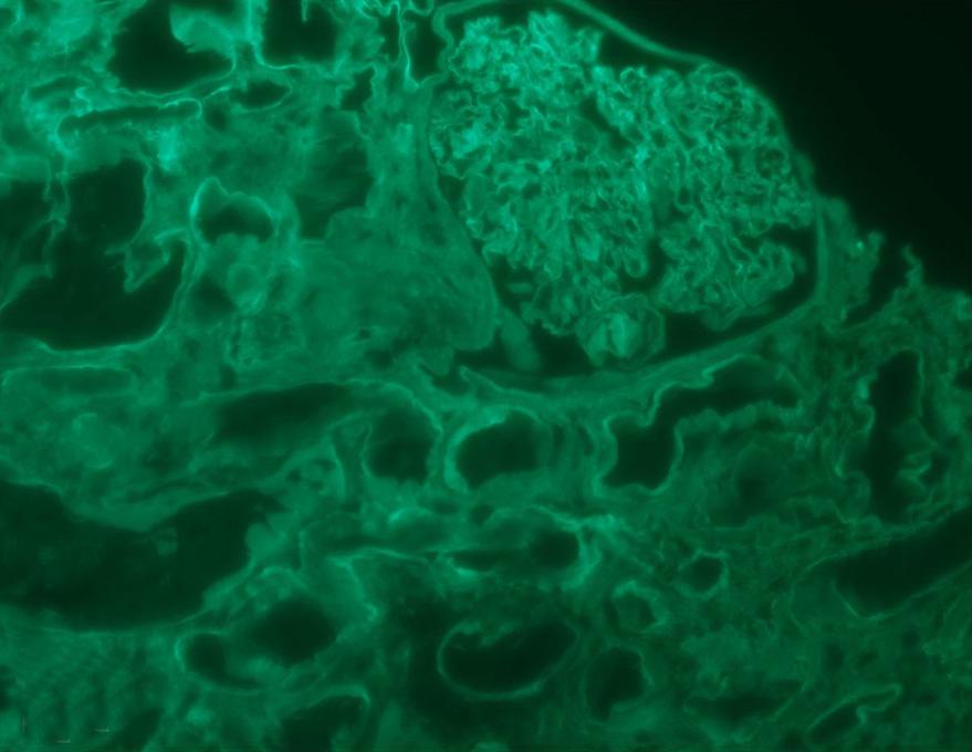 (B) Immunofluorescence microscopy ( 200) with fluoresceinated anti-kappa-antibodies showed linear staining involving glomerular and tubular