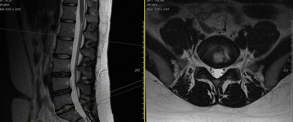 소견듣고물리치료받은후미약호전하여본원내원하였다. 6) 치료부위 T12 좌측면관절 7) 영상의학적소견 (L-spine MRI) L3/4/5:Central broad based protrusion disc L5/S1:Diffuse mild bulging disc 치료만진행하였다. 12월 26일 NRS 1, ODI 2.22, EQ-5D 0.