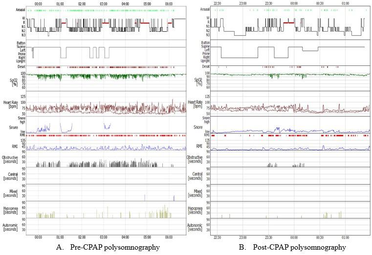 Korean J Clin Lab Sci. Vol. 51, No. 1, March 2019 121 Figure 1. The comparison of pre- and post-cpap on hypnogram. 95th Percentile: 7.7 cmh 2O, 최대압력 : 8.8cmH 2O이었고, 무호흡-저호흡지수는 0.8로관찰되었다.