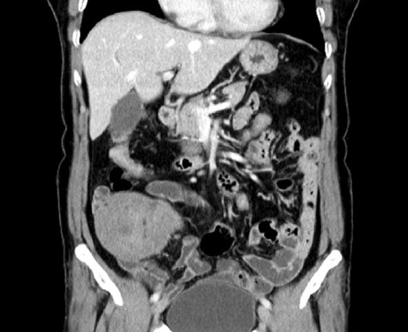 Ewha Med J Vol. 35, No. 1, 2012 Fig. 1. Abdominal CT findings. 10 6.5 cm sized solid mass is visible in right lower quadrant. The tumor originates from small bowel mesentery. (A) Horizontal view.