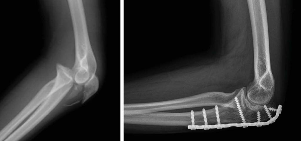 Fig. 1. (A) Lateral radiograph of anterior transolecranon fracture-subluxation. (B) Lateral radiograph of the same patient following fixation with a contoured reconstruction plate.