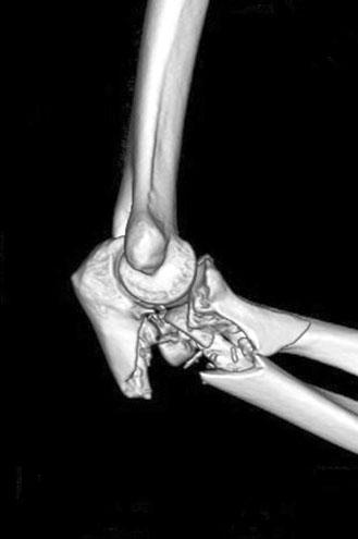 olecranon process fractures and hinged external fixation for elbow instability. (A) Preoperative elbow anteroposterior (AP) image.