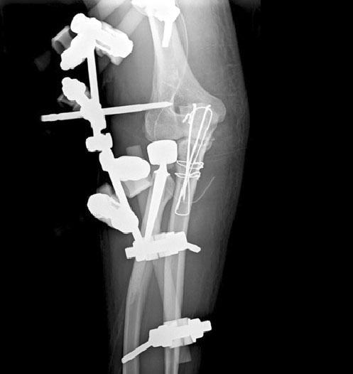 (E) Postoperative elbow lateral image. 위를서서히증가시켰다. 수술 6 주전, 후 ( 평균 6.8 주, 5-8 주 ) 로불안정성여부를확인한후외고정장치를제거하였다. 3.