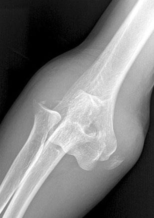 Additional Hinged External Fixation in Complex Elbow Injury 173 Fig.