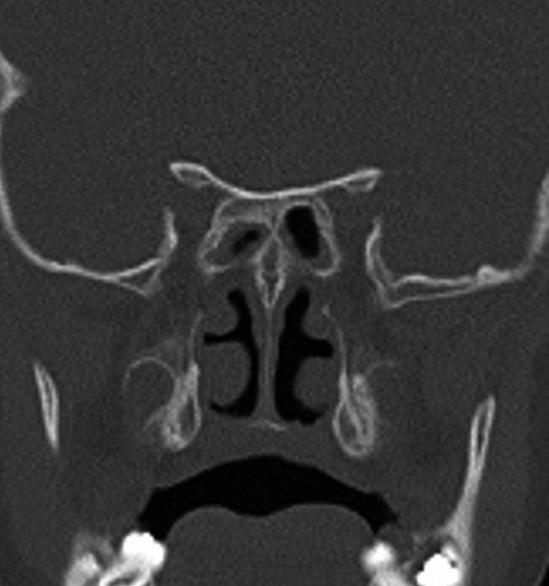 Endoscopic view of the right nasal cavity.
