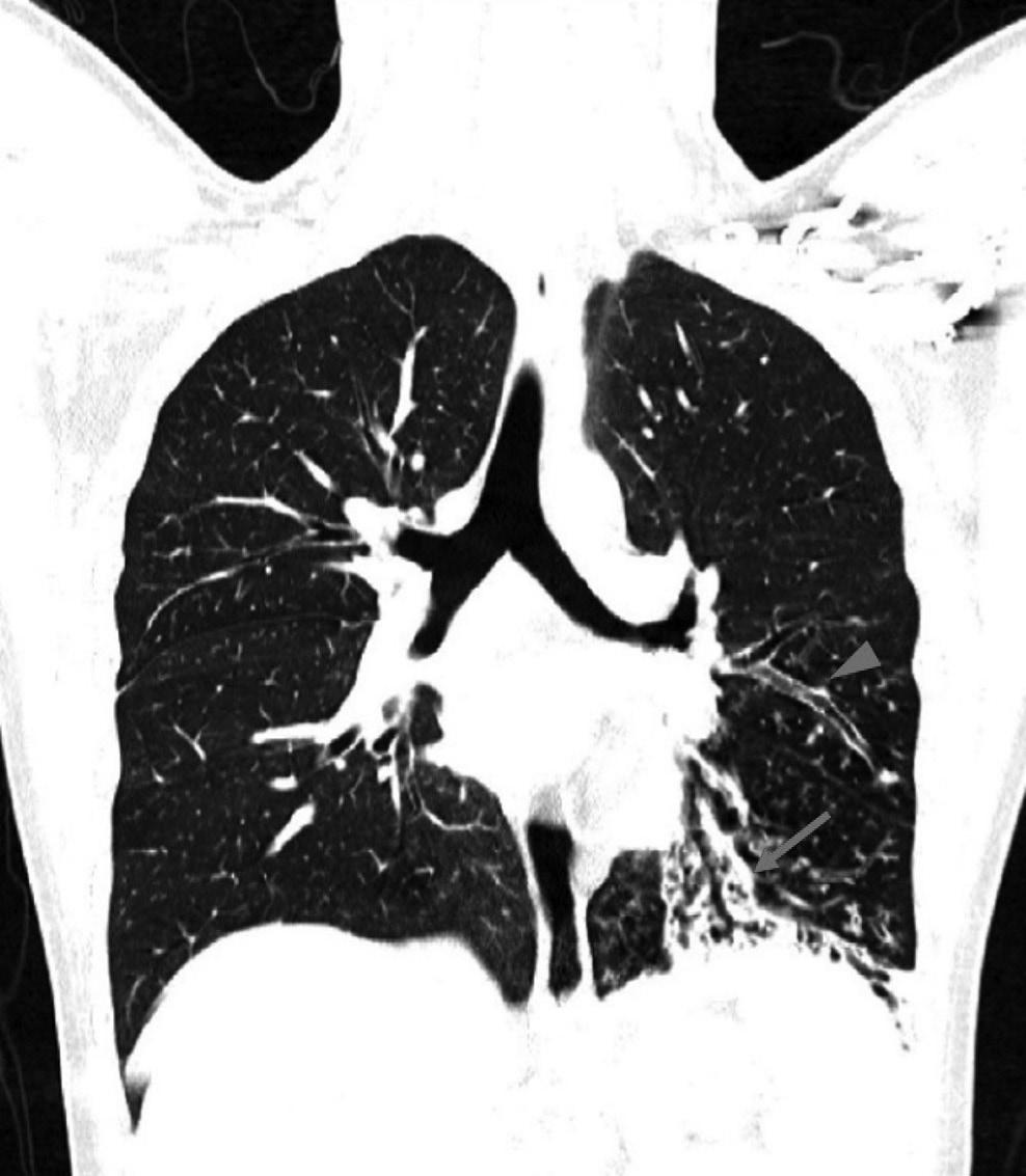 Chest CT scan (coronal view) shows bronchial wall thickening (arrow) and tram-track sign