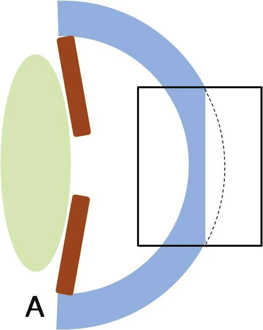 - 박진형외 : 라섹수술후전안부변화 - A B C D Figure 4. The schematic figures of change of the cornea after LASEK surgery. (A) Section of cornea during LASEK surgery.