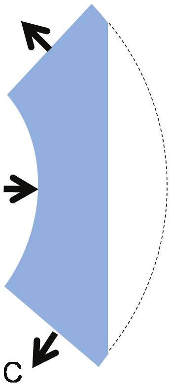 Because of tensile strength, the iris was displaced anteriorly resulting in the anterior chamber angle, volume, and depth was decreased. 얕고, 앞방각이좁다고하였다.