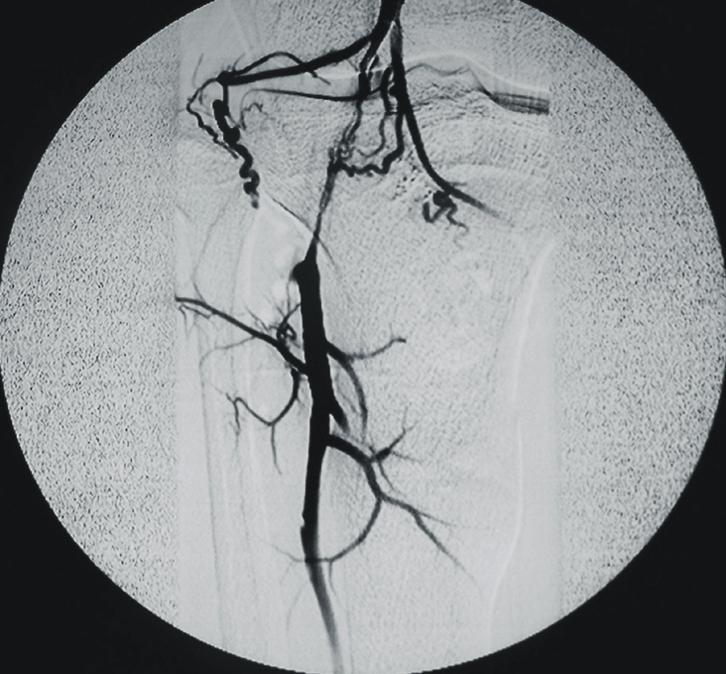 530 A B Fig. 3. (A) Angiogram (case 5) showing an occlusion of the popliteal artery 6 months after the corrective osteotomy. (B) The delayed angiogram showing a well developed collateral circulation.
