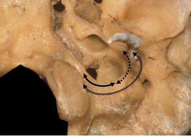 이전방접근법에는내시경경비적 / 경상악동경익상골접근법 (endoscopic transnasal/transmaxillary transpterygoid approach), [17] 경관골-경하악골접근법 (zygomatic-transmandibular approach), [18] B형, C형측두하와접근법 (infratemporal fossa approaches