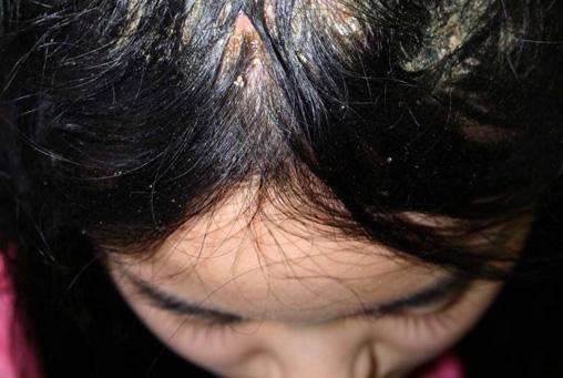 the frontal scalp Fig. 4.