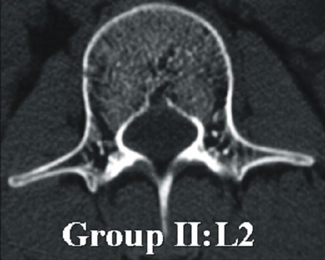 Group II was characterized by the narrow pedicular canal. However, the pedicular length and insertion angle had increased.