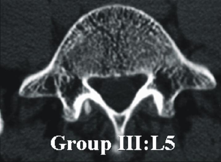 Group IV was characterized by it s the largest decrease in the pedicular canal and length.