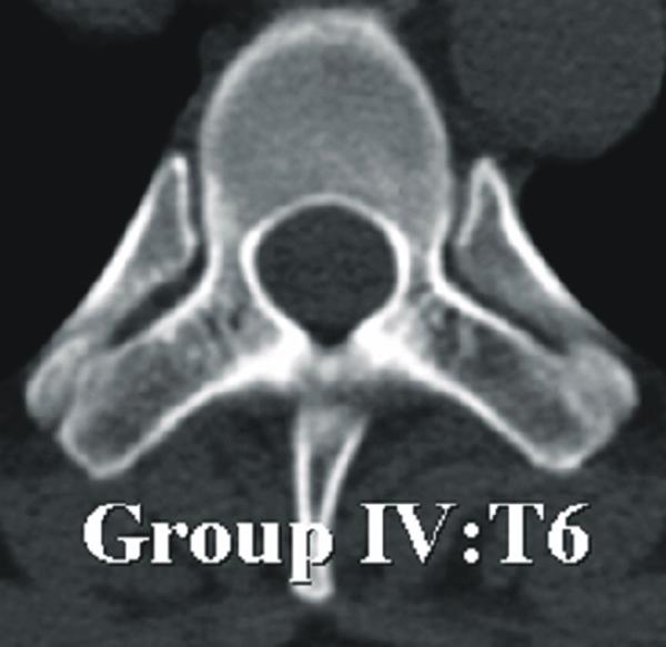 In Group VI, the pedicular canal was wide and its length and insertion angle had increased compared with those of the other groups.