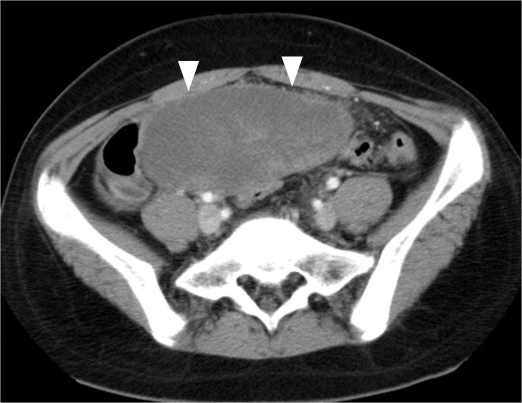 CT에서낭성종괴의벽은평균 11 mm로두꺼워져있거나, 낭종벽의한쪽만 10 mm 이상두꺼워져있으면출혈성경색을의미하며출혈성경색이없으면 3 mm 이하이다 (5). 부난소낭종 (paraovarian cyst) 은난소와나팔관사이의자궁광 인대에생기는낭종으로자궁부속기의낭종중에서는약 20~30% 정도발생한다 (2). 대부분이 30~40 대여성이며소아에서는드물다.