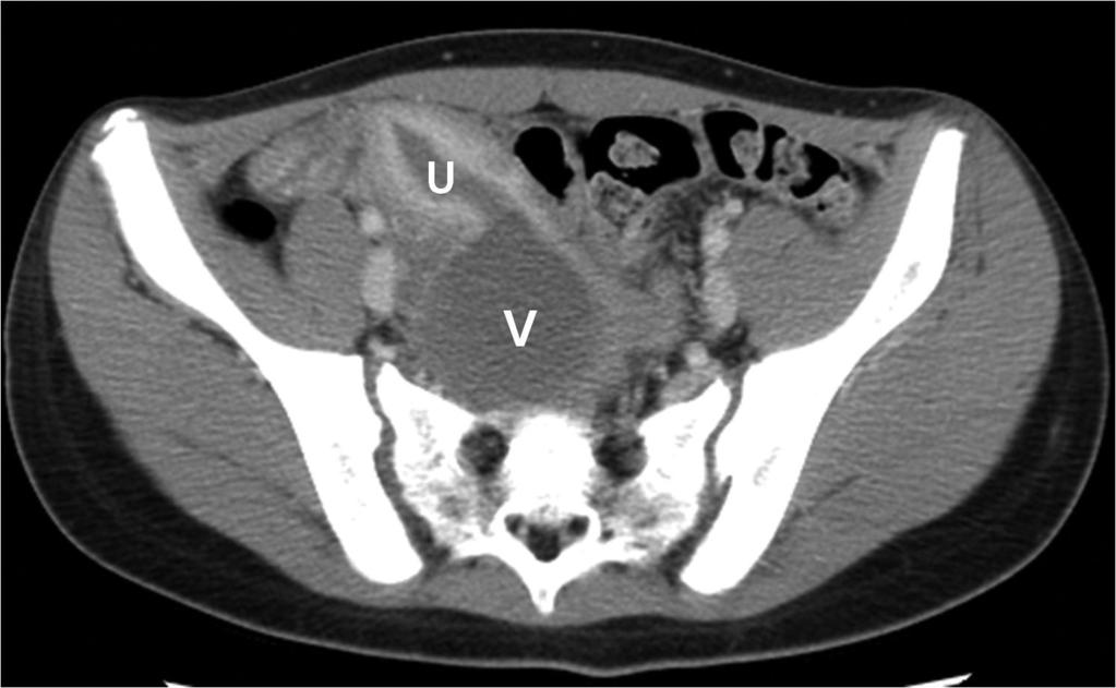 청소년기의급성부인과계질환 C Fig. 11. Transvaginal septum in a 10-year-old girl who presented as lower abdominal pain and hypermenorrhea.