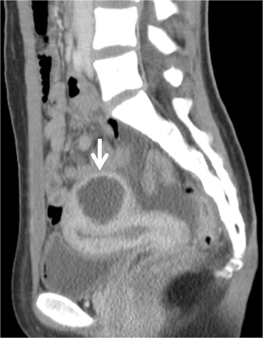 골반통을주소로한청소년기의여아에서자궁근층에낭성종괴가보이면드물지만낭성자궁선근종으로진단할수있다 (10). Fig. 16. Cystic uterine adenomyosis in a 14-year-old girl who presented with lower abdominal pain for two days.