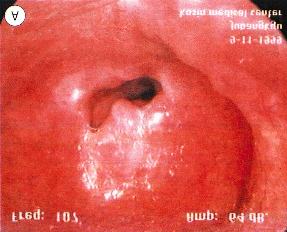 to posterior, -L Split right to left, rregular or loose-baggy vibration, egular mucosal wave, Anterior n vibration of neoglottis, anterior portion is predominant, n vibration of neoglottis, posterior