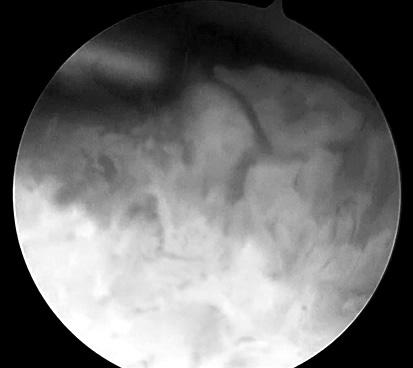A B C Figure 5. (A) Postoperative X-ray shows disappeared radiolucent cavity.