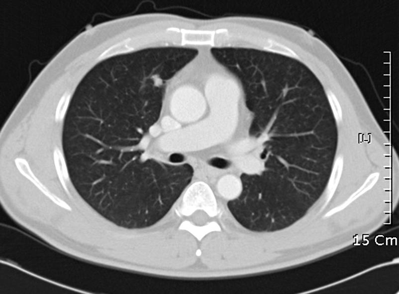 right middle lobe that is adjacent to mediastium (A, B).
