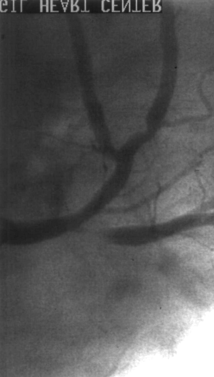 A B Fig. 1. Coronary angiographic finding. A pre-stenting B poststenting+high pressure balloon inflation ±0.35 mm였으며 stent전 최소혈관내경이 0.58±0.29 Table 2.