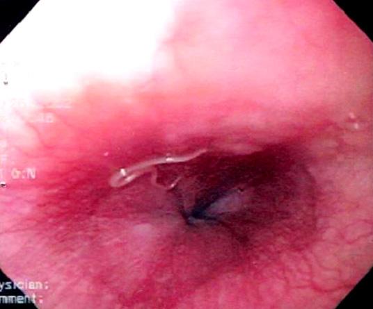 (C) Markedly edematous gastric mucosal folds, a shallow ulcer with adherent dark blood clots, and a worm penetrating into adjacent gastric mucosa are shown in the body.