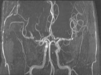Preoperative right carotid angiogram shows right middle cerebral artery stenosis. B.