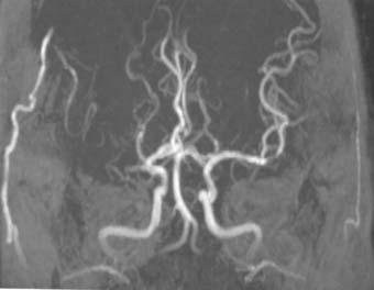 Postoperative external carotid angiogram shows extensive revascularization through patent bypass. Fig. 2. Postoperative delayed occluded case A.