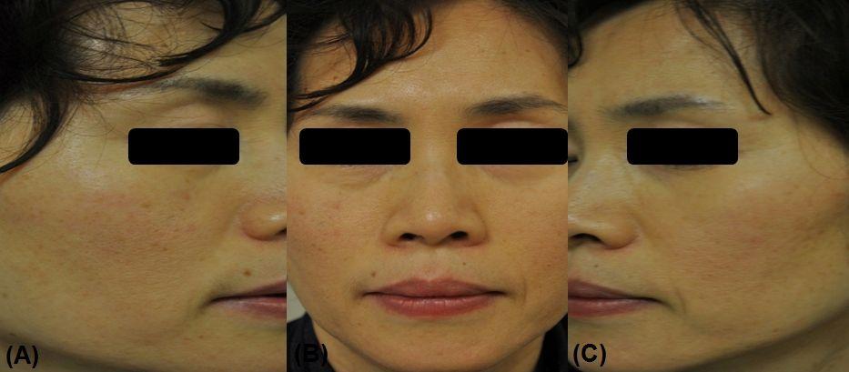 Figure 2 Improvement of a 54-year-old woman with many fine and coarse