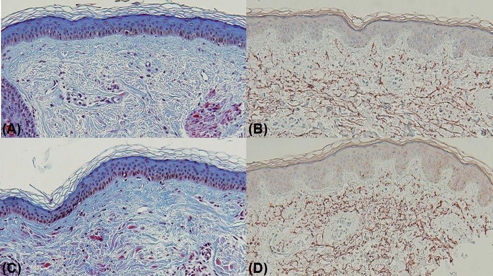 Figure 6 Masson s trichrome stains(a,c) and immunohistochemical stains for tropoelastin(b,d).