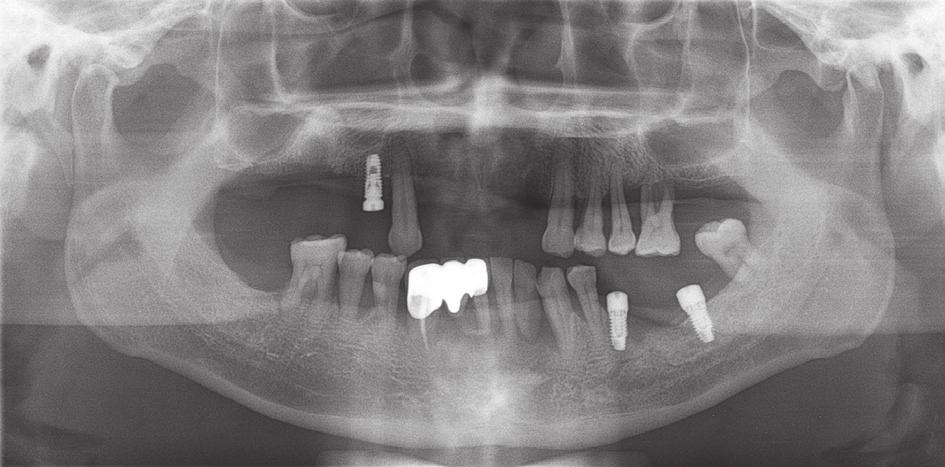 Full mouth rehabilitation of a patient using monolithic zirconia and dental /M system: a case report 전 무치악 환자에게 T guided surgical stent를 이용하 득하여 모형을 제작하였다.