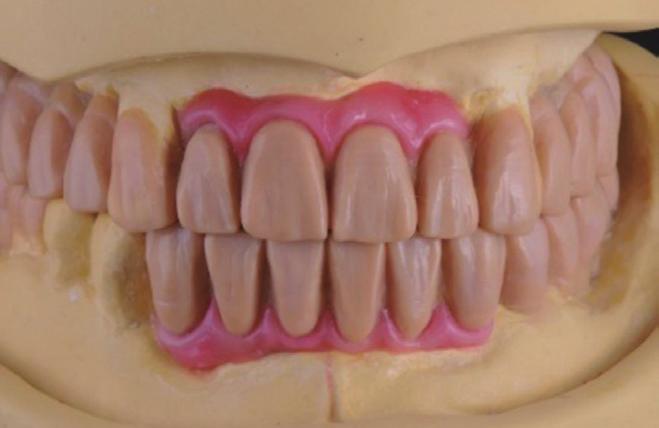 Temporary denture delivery after teeth extraction.