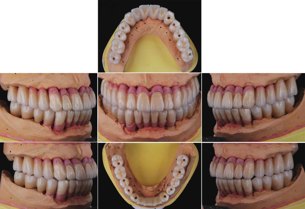 Full mouth rehabilitation of a patient using monolithic zirconia and dental /M system: a case report E F G Fig. 17. efinitive prosthesis on master cast.