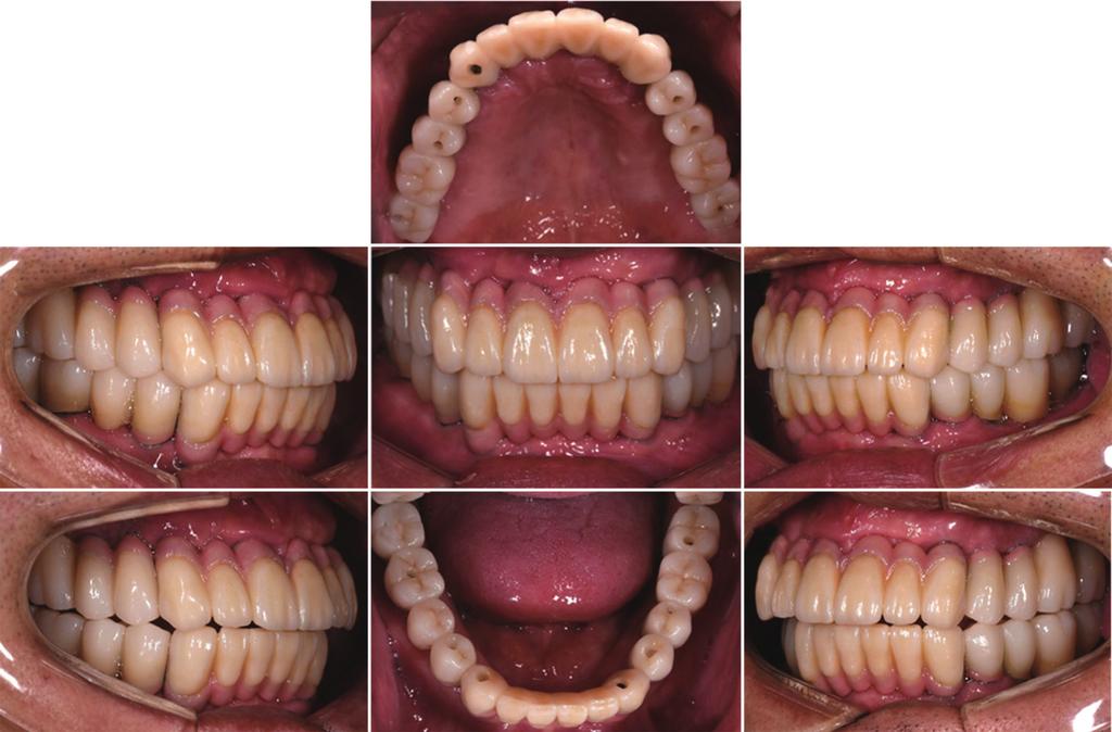 movement - left side: group function. E F G Fig. 18. efinitive prosthesis delivery. Group function with shallow anterior guidance was adopted for occlusal scheme.