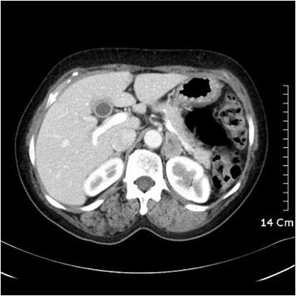 () bdominal computed tomography showed a well enhanced left adrenal mass. Figure 4.
