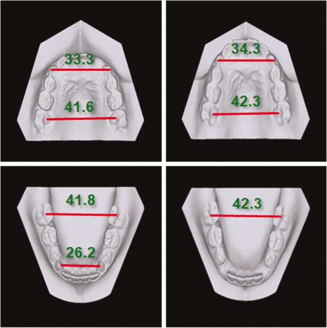 0 mm로치료전과치료후의횡적인악골의변화는거의없었다 (Fig. 9). Ⅲ. 총괄및고찰 Fig. 6. The measurements of maxillary and mandibular arch widths before and after the treatment. 3.