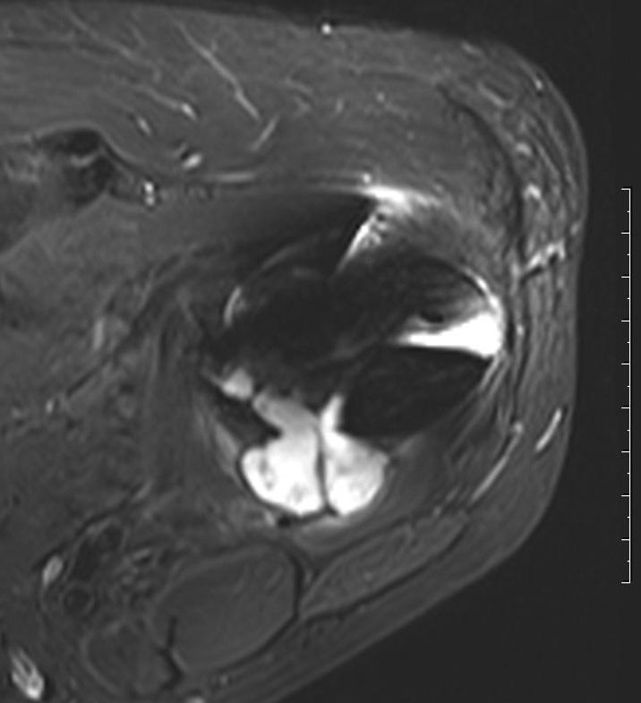 (A) The initial coronal T2 weighted magnetic resonance imaging (MRI) shows an intraosseous well-marginated