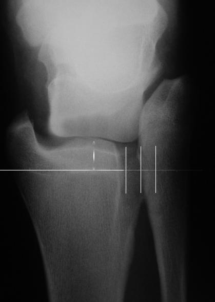 147 Kwi Youn Choi, et al. Management of High Ankle Sprain 력, 이학적 검사 그리고 일반적인 방사선 검사에서 진단이 명백하 되거나 경골 너비의 42%를 초과하여야 하며 격자상에서는 1 mm 지 않을 때 시행되며 국소 족관절 신경 마취를 통해 정확성을 높일 를 초과하여야 한다.