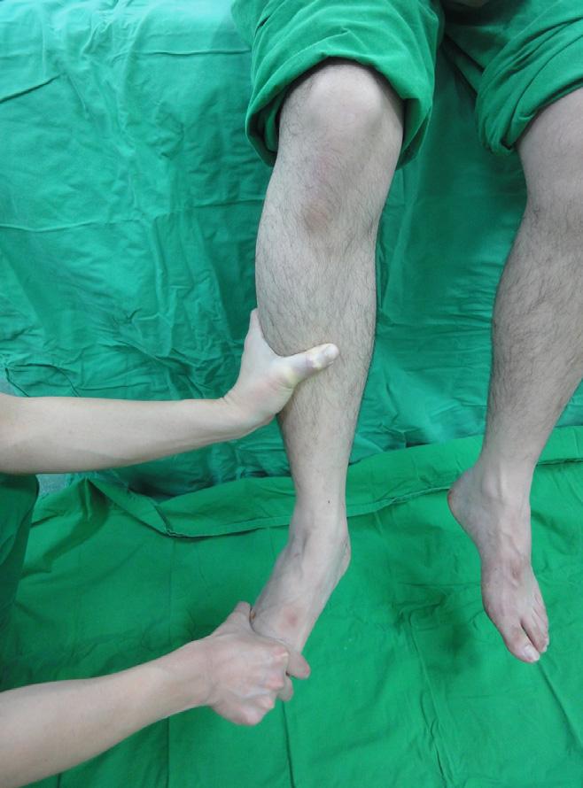 1) Squeeze test와외회전부하검사 (external rotation test, Frick s test), cross-legged test는골절을동반하지않은족근관절원위경비인대결합손상의진단에유용하게활용할수있다.