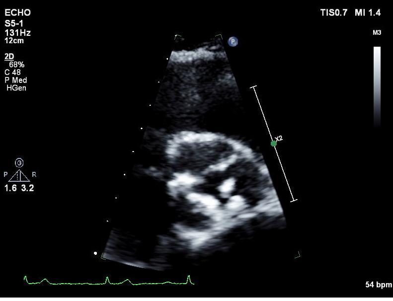(A) Initial chest PA showed normal finding on both lung field, no 