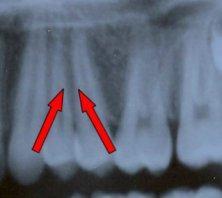 37 파노라마방사선사진은상의변형이있기때문에, 치근각도를평가할때견치와인접치아의치근관계에대해서는평가를하지않습니다.