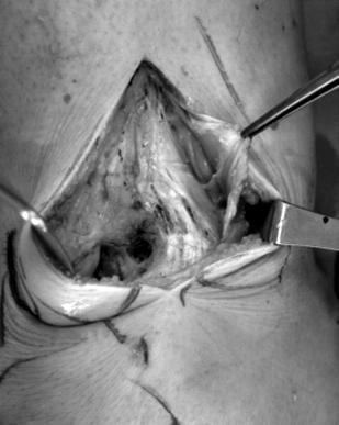 16) 천부내측측부인대 (superficial medial collateral ligament) 를부분박리하는방법은 2가지가있으며, 첫째는내측측부인대를확 Proximal Patella tendon 2 3 X A Figure 2.