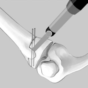 During uniplanar osteotomy, a metal block is fixed to the plate using screw. A B Figure 8.