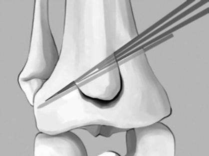 (B) The 3 or 4 chisel technique is used to open the site of osteotomy.