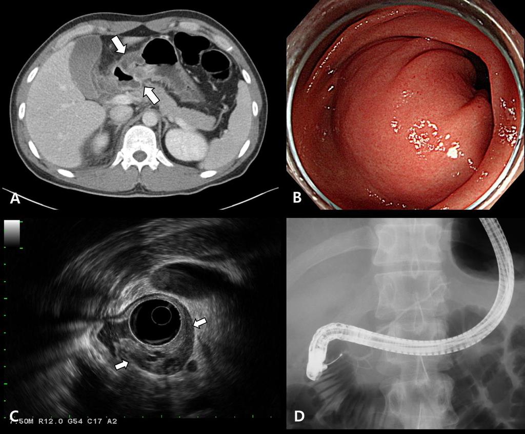그림 1. 복부전산화단층촬영에서전정부위벽의비후와위벽주위염증및액체저류가관찰되었다 (A). 내시경검사에서전정부의상피하병변이관찰되었으며 (B), 초음파내시경에서주로 3층과 4층에위치하며내부에무에코의관상구조를동반한저에코성병변으로나타났다 (C). 내시경역행담췌관조영술에서췌관에는특이소견관찰되지않았다 (D).