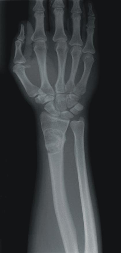 (A) 10-year-old boy with an active cyst on his right proximal