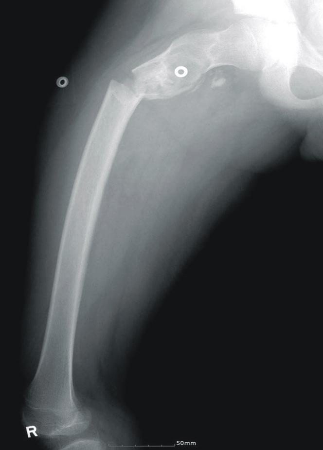 intramedullary nailing with an open curettage and allograft