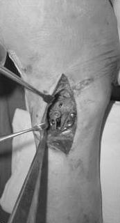 (C) As the 1st stage treatment, the Pilon fracture was realigned and stabilized