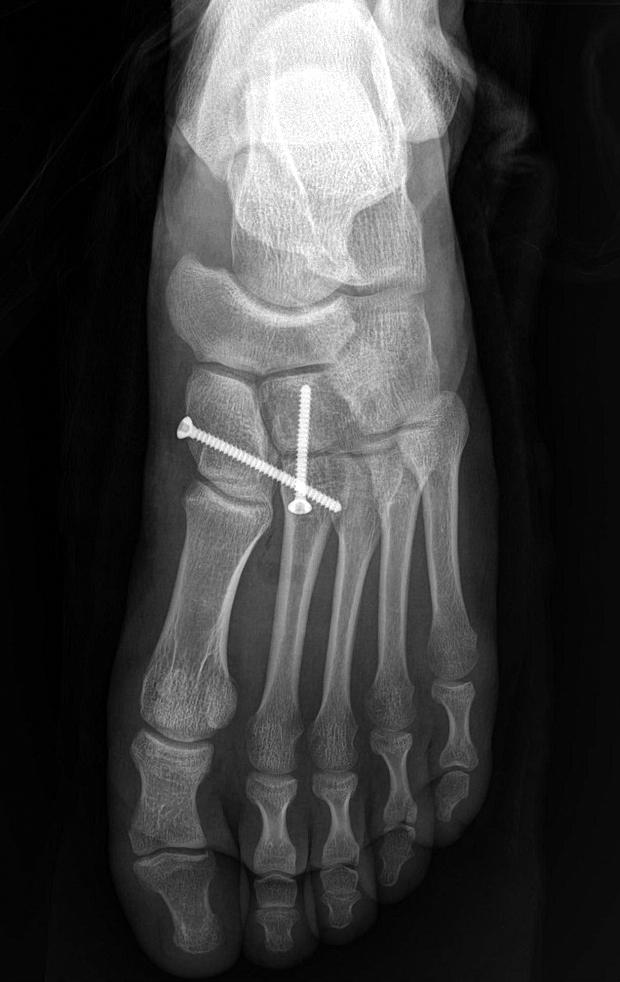 (D) Postoperative AP radiograph shows broken screw remnant in middle cuneiform bone. A B C Figure 2. on-broken screw case.